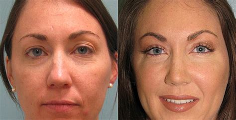 Bellafill los angeles  Bellafill is a new breed of filler to treat wrinkles caused by lost volume
